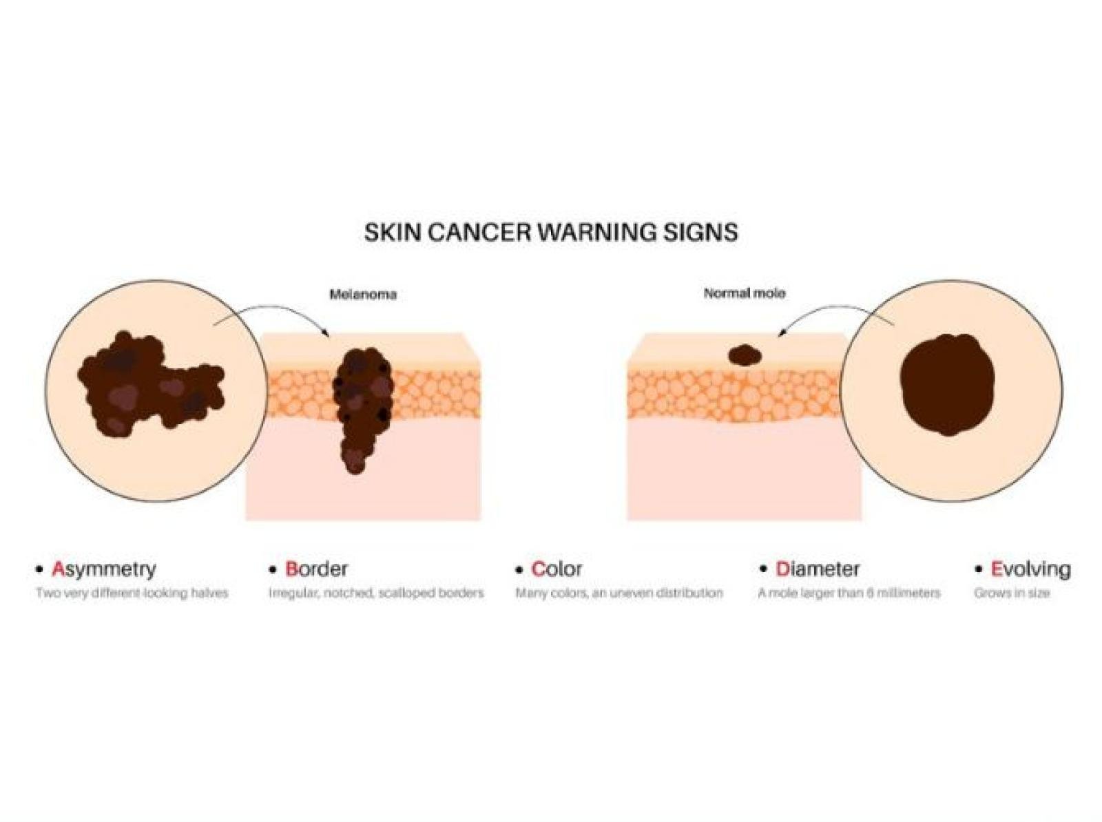 Early Detection: What to Look For &amp; How to Check Your Skin